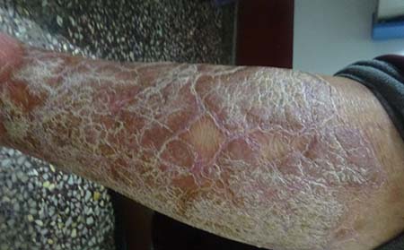 银屑病患者在秋季怎么预防