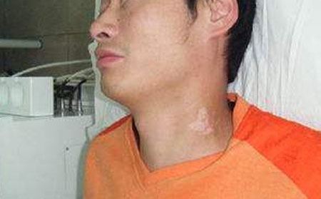 白癜风的患者应该如何护理