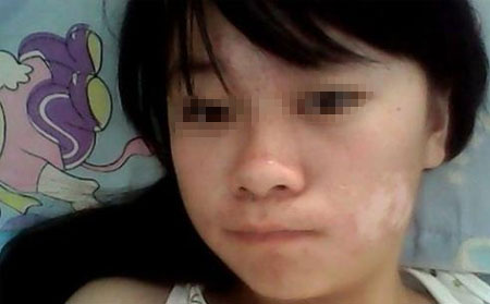 白癜风发生的原因有什么