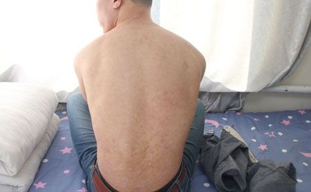 什么样的症状是银屑病