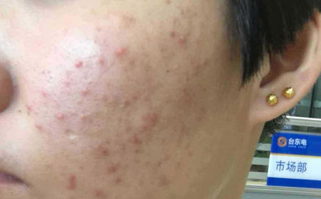 潍坊发生青春痘应该怎么护理
