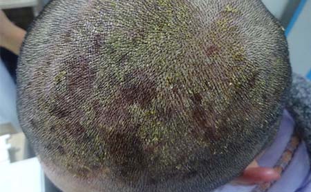 头部银屑病护理,头部银屑病冬季护理