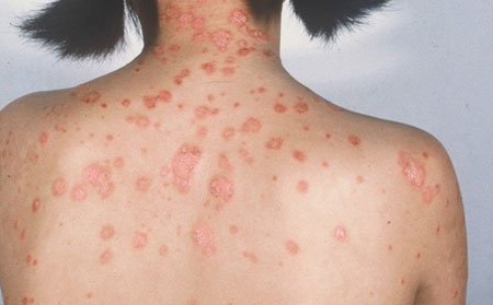 儿童牛皮癣治疗,儿童有牛皮癣怎样治