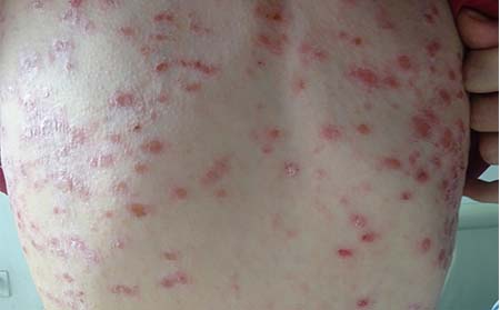 皮肤牛皮癣症状,牛皮癣有什么症状