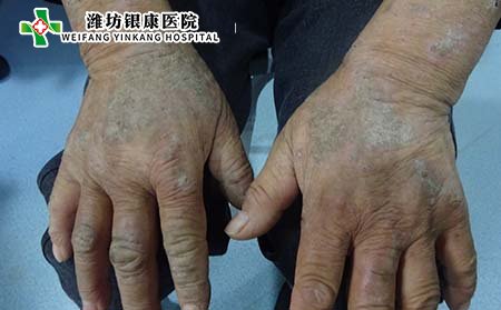 手部关节型银屑病治疗,怎样治手部关节型银屑病