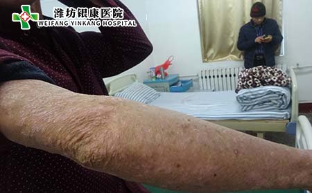 牛皮癣治疗,得牛皮癣要不要治疗