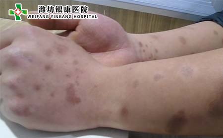 关节型牛皮癣危害,关节型牛皮癣治疗