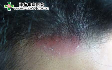 头上银屑病症状,头部银屑病症状,潍坊东方银屑病研究院