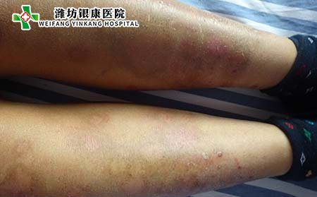 寻常型银屑病治疗,怎样治寻常型银屑病