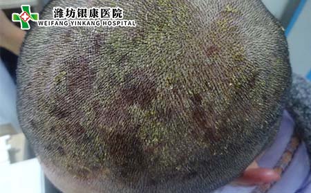 银屑病症状,头部银屑病的症状