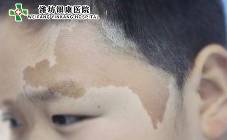 黄褐斑病因,女性黄褐斑病因