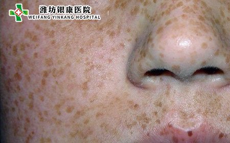 雀斑,怎样预防雀斑