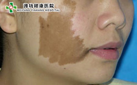 黄褐斑,冬季黄褐斑