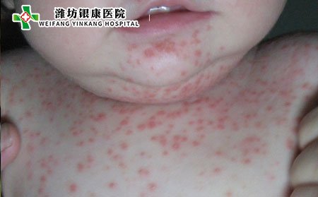 银屑病治疗,儿童银屑病治疗