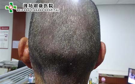 牛皮癣症状,头部牛皮癣的症状