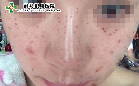 雀斑症状,脸上雀斑症状表现