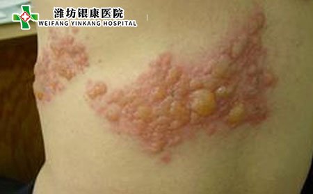疱疹,皮肤疱疹
