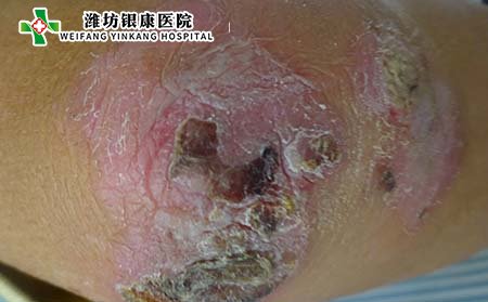牛皮癣人群,易得牛皮癣的人群