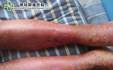 寻常型牛皮癣有几种表现类型?