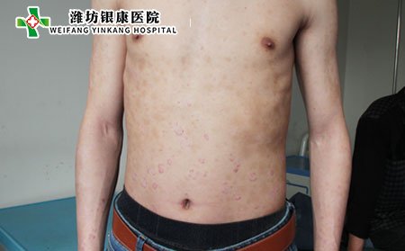 潍坊牛皮癣医院:得了牛皮癣怎么办