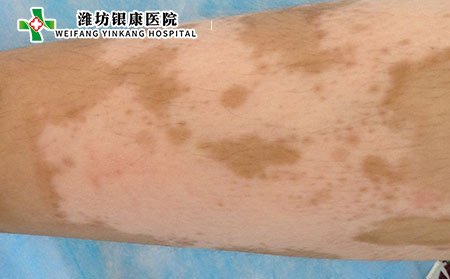 潍坊皮肤病医院：典型白癜风症状、治疗