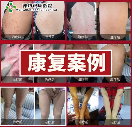 银屑病皮肤病专家会诊康复案例 银屑病皮肤病专家会诊康复案例