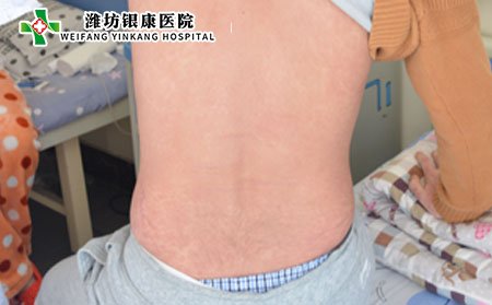 牛皮癣与脂溢性皮炎有什么区别?治疗牛皮癣方法？